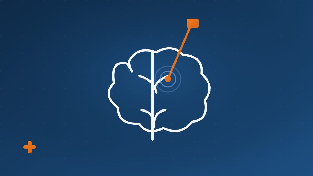 DBS, estimulação cerebral profunda no Parkinson — ilustração Movimento+